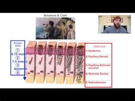 measuring melanoma thickness|melanoma clark level vs breslow.